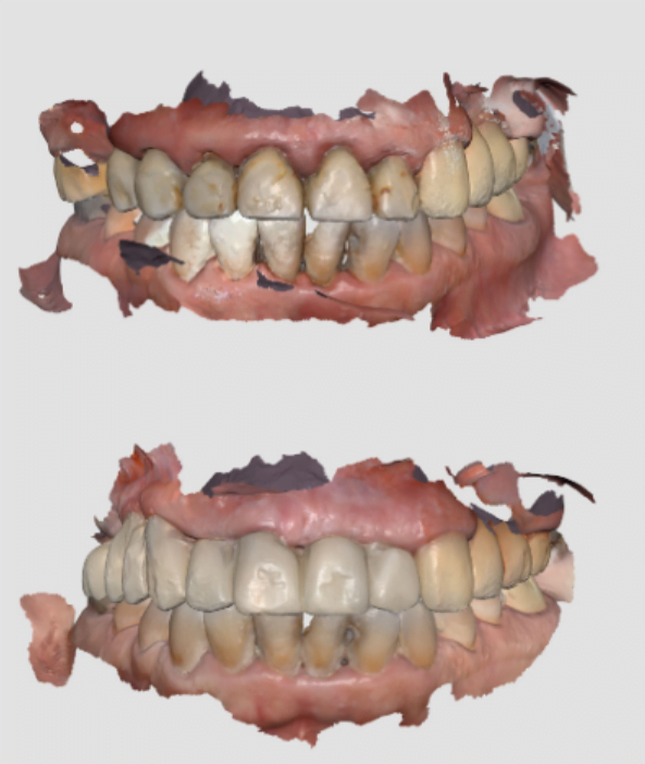 Scanned images of the initial state of the teeth and bridge