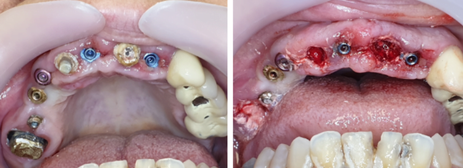 Removal of residual teeth before installing a permanent prosthesis