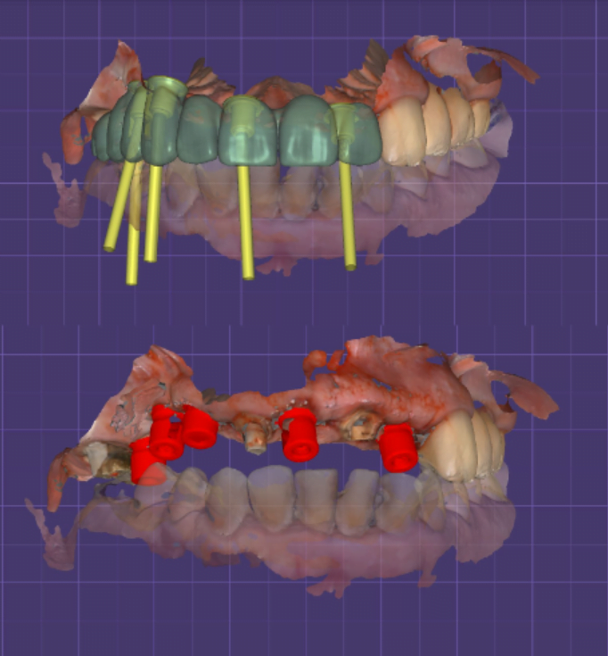 Digital photograph of the prosthesis indicating the direction of the screw channels and a photograph showing the scanned abutments