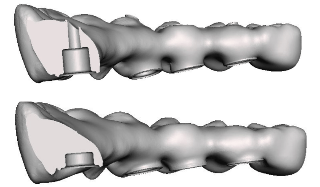 Bridge digital models: top image 4 mm sleeve with screw channel (causing breakage); lower image 1. 5 mm sleeve without screw channel