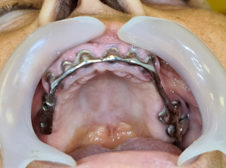 Metal bar that is fixed on the patient's teeth