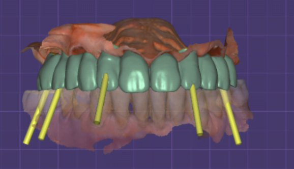 New temporary bridge for immediate placement in the patient's mouth