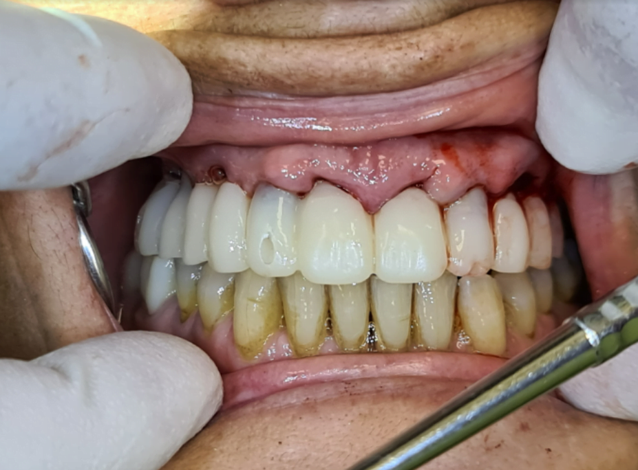 Installing a prosthesis in the patient's mouth