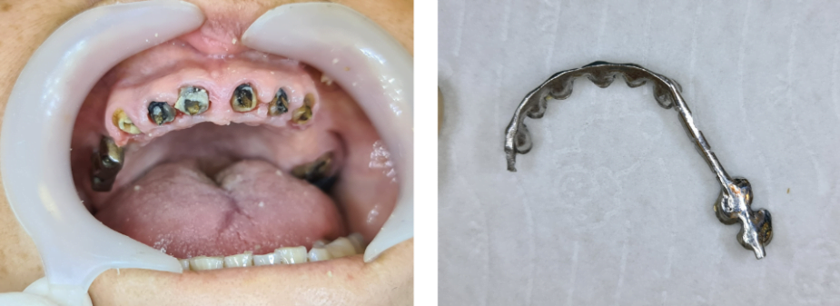 Condition of the teeth after the metal bar was removed