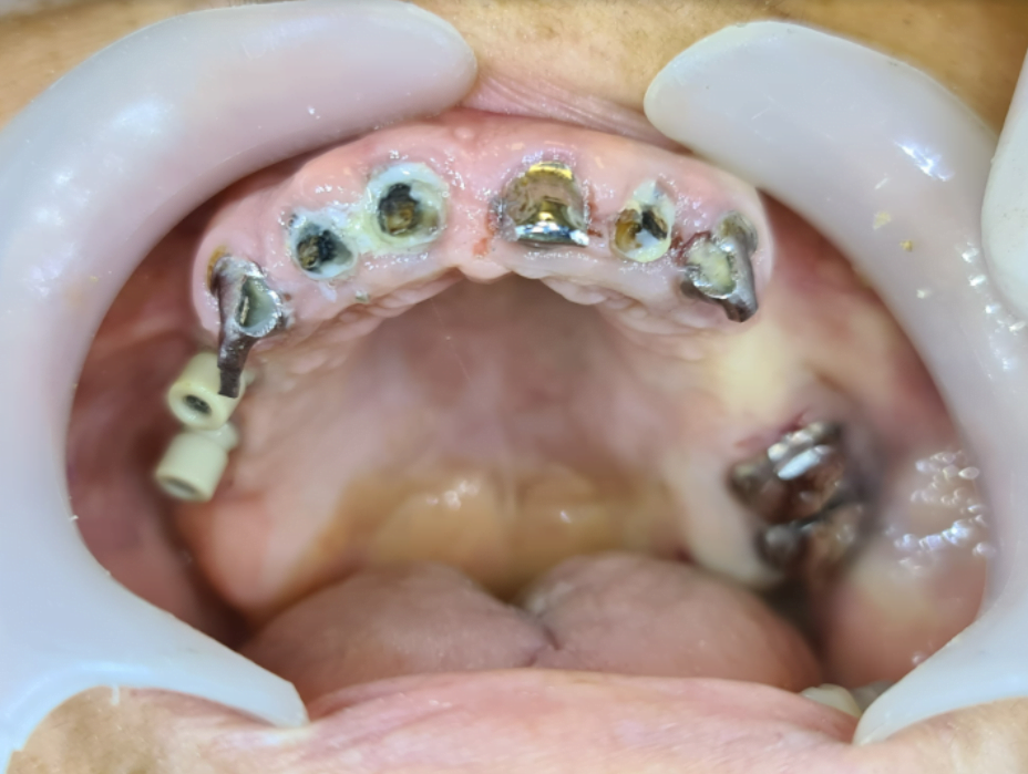 Remaining teeth to be removed