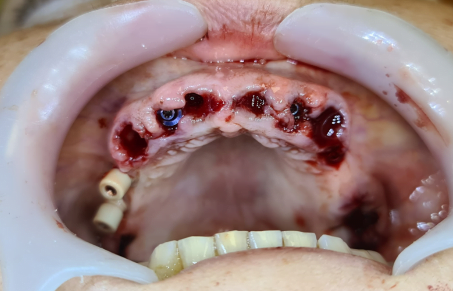 Jaw after tooth extraction and with implants installed