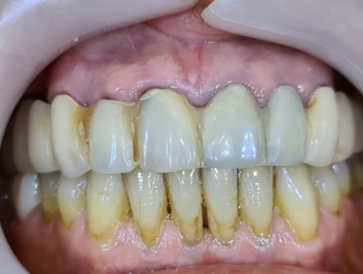Metal-ceramic prosthesis based on prepared teeth