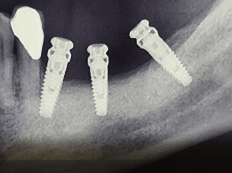 X-ray with three implants