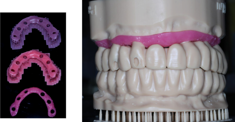 How to align digital analog to 3d printed model of dental implant | cad cam digital planning how to align digital analog to 3d printed model of dental implant 10