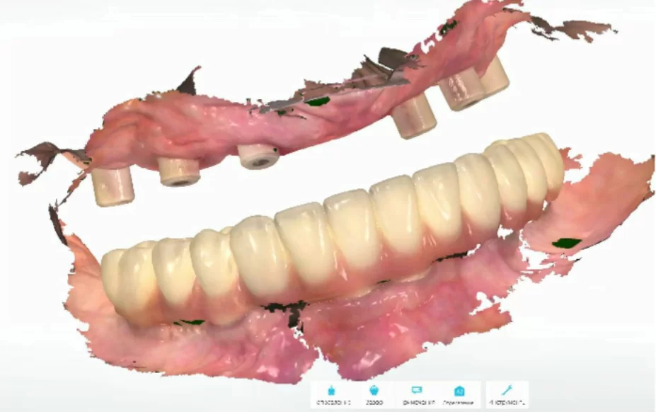 Digital model using scan abutments (on the upper jaw) and a bridge prosthesis (on the lower jaw)