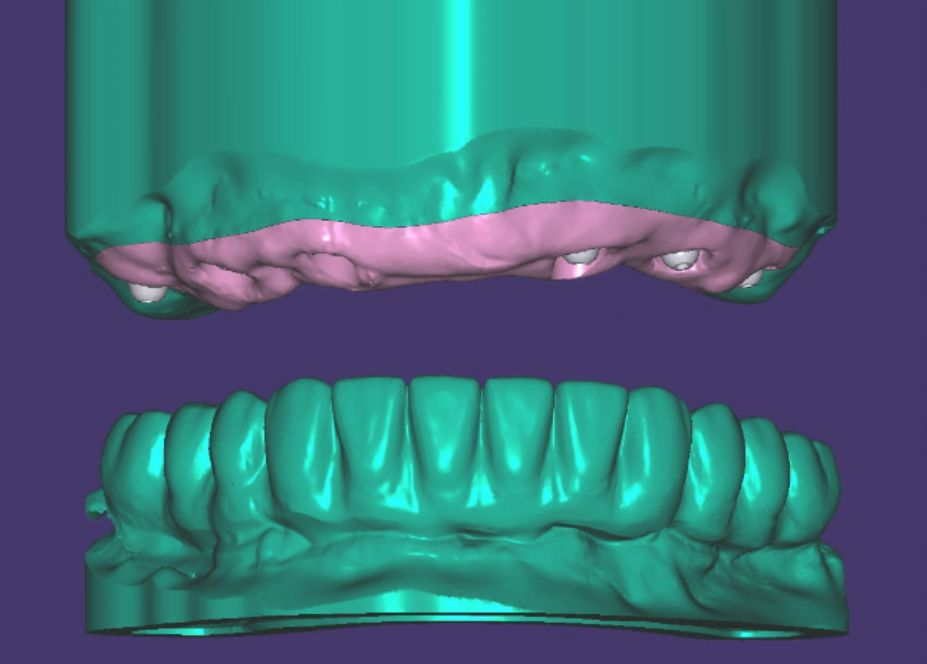 Metal-ceramic prosthesis - base with screw channels and porcelain crowns