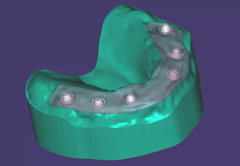 Upper jaw model with implant analogs