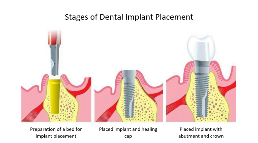 Stages of dental implant placement