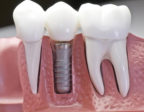 Dental implants picture1 1