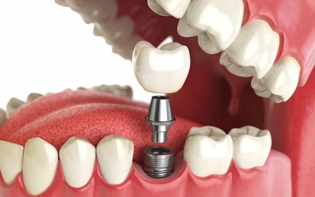 Dental implants have many clear advantages