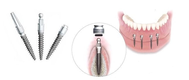 Standard dental implants have two main parts - the abutment and artificial root.