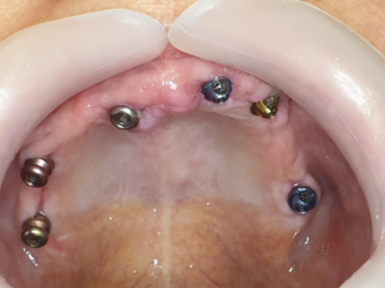 The old prosthesis with which the patient came - there are chips and gaps between the teeth are poorly expressed