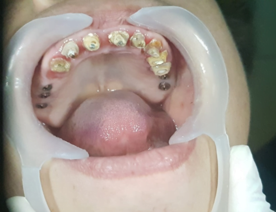 Teeth after removal of the bridge are subject to removal