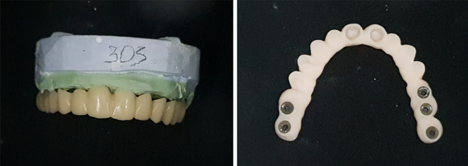 Temporary restoration with fixation on multi-unit abutments and support on the remains of the anterior incisors