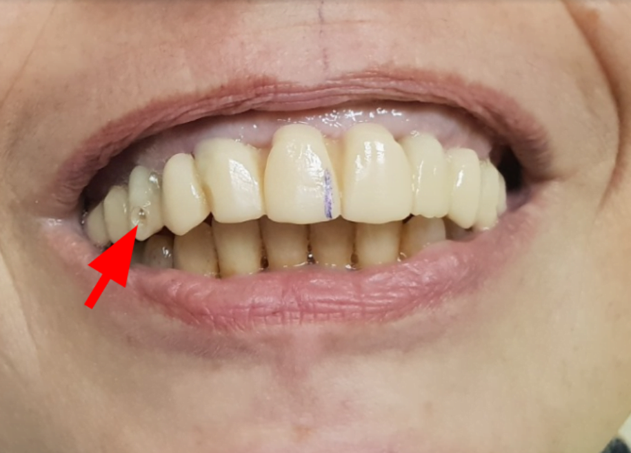 Temporary restoration which shows the hole from the old implants, as well as the displacement of the center line of the prosthesis