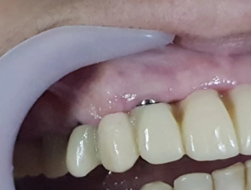 Cosmetic defect - the gum exposes part of the titanium element