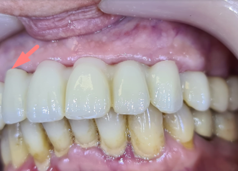Excellent aesthetic result - the colored titanium abutment is almost invisible