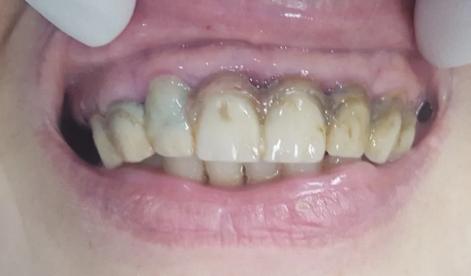 An old bridge made of zirconia with an artificial gum, the photo shows defects and pigmentation disorders