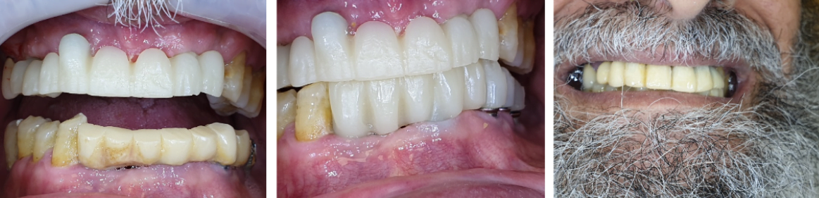 The final result is a new zirconia prosthesis that looks great