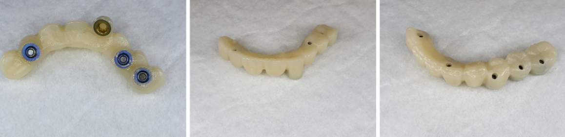 Finished zirconium prosthesis on which a cosmetic defect from the screw shaft has been eliminated