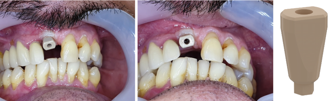 Scan abutment installed at the level of the implant to work with an intraoral scanner