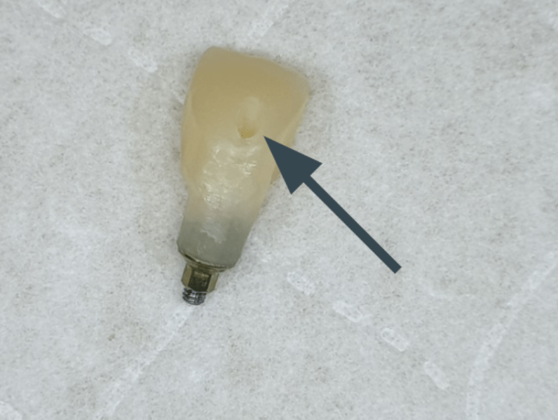 Temporary crown showing the screw shaft