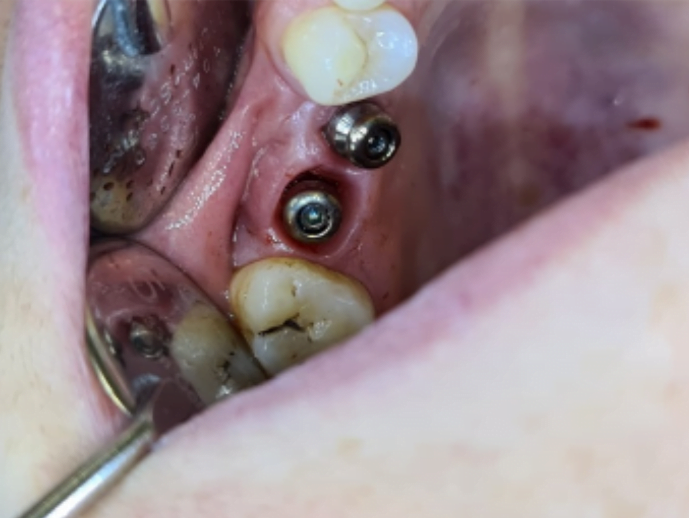 Healing caps installed on implants for the period of gum healing