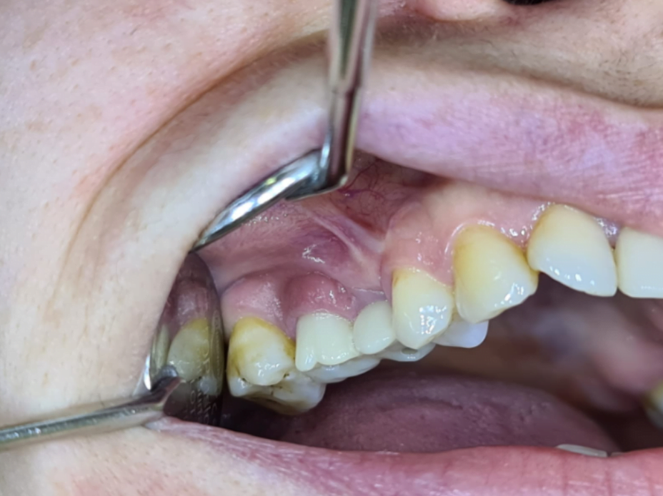 Inflamed gum around one of the implants