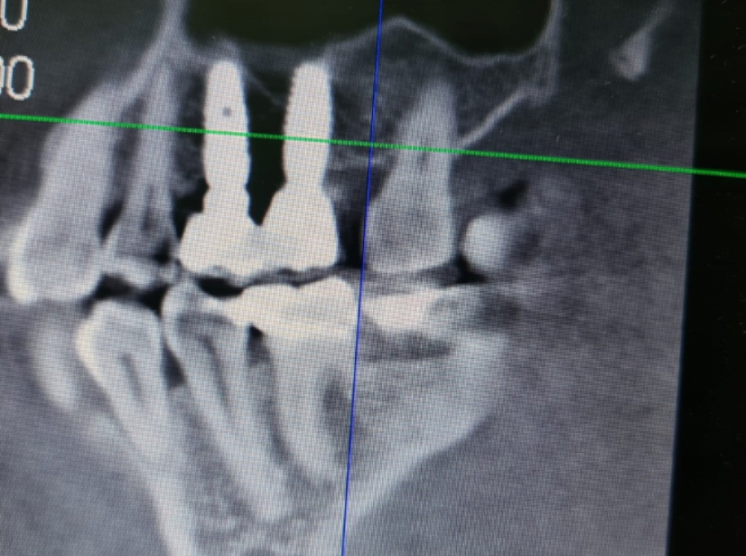 A picture of implants with a bridge that shows a slight loss of bone tissue
