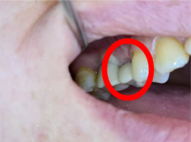 Dental bridge where you can see that the gum is healthy, and one of the crowns is very small and it is extremely problematic to perform such a restoration with cement