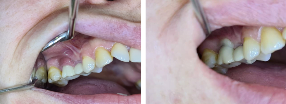 Pictures of the patient's oral cavity at the time of treatment and at the time of installation of the prosthesis in place after the healing of the gums