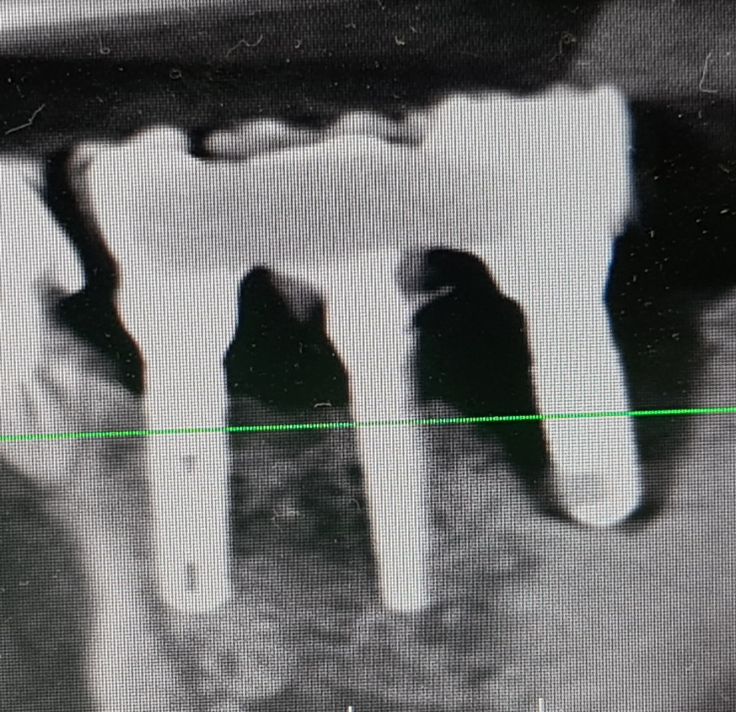 X-ray showing that one implant is outside the bone tissue