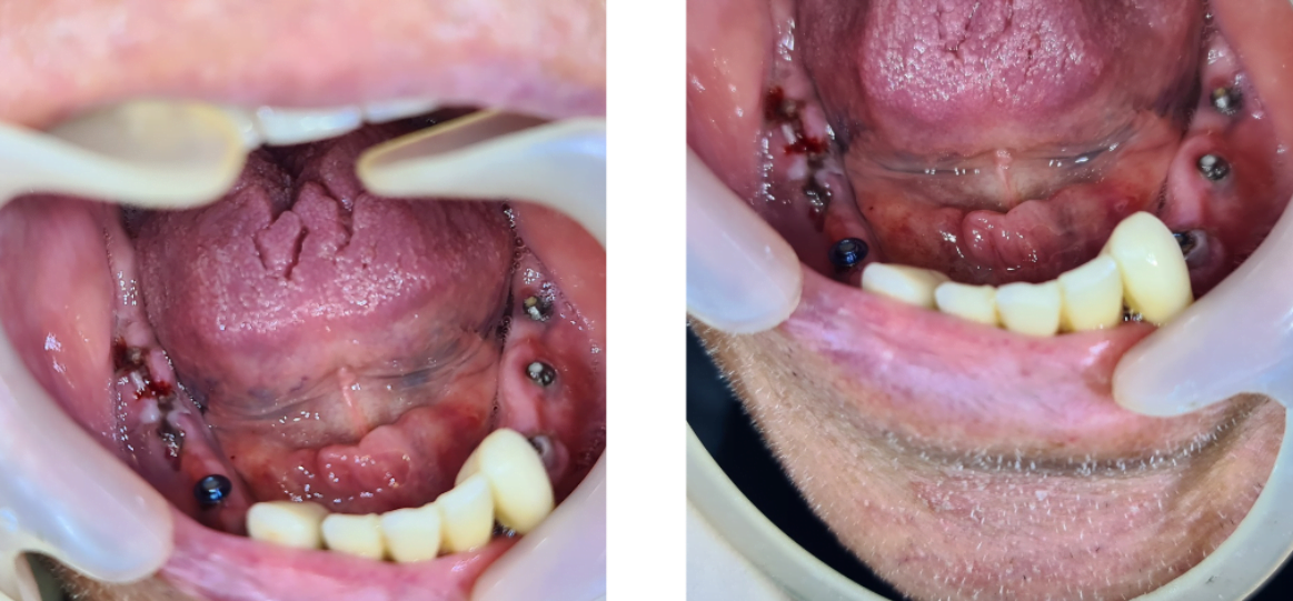 Patient's oral cavity after removal of old prostheses and one implant