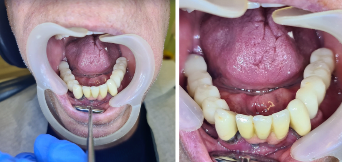 The state of the patient's oral cavity after the installation of new dental bridges