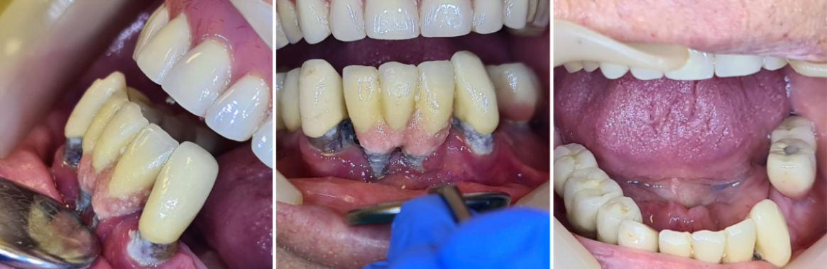 Dentures in poor condition that need to be removed