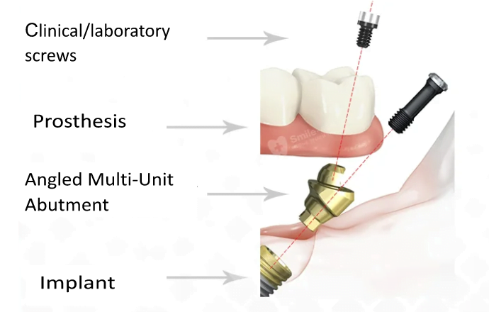 The general principle of prosthetics on multi-units