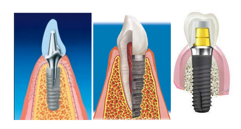 Straight abutment transgingival placement
