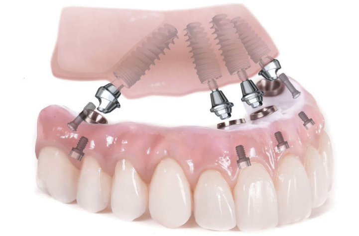 Advantages and disadvantages of the technology for installing dental implants on ball abutments