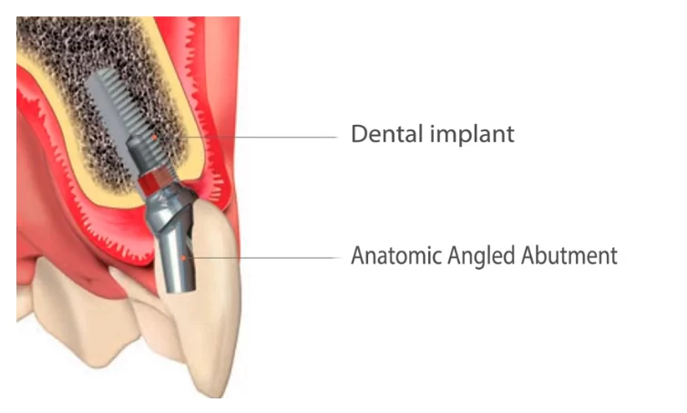 Anatomic angled abutment
