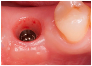 A high-quality attached gingiva characterized by excellent density and width, indicating a high likelihood of implant stability.