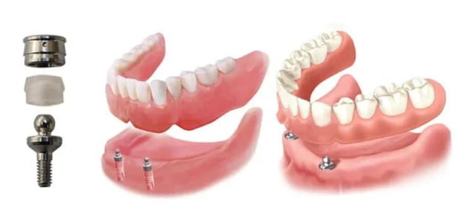 Abutments for conditional removable dentures