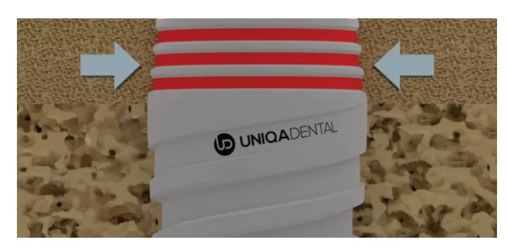 UNIQA DENTAL implants as an example