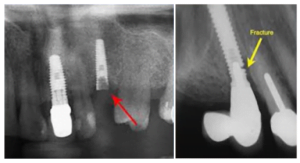 The risk of fracture of the top of the implant together with a straight abutment