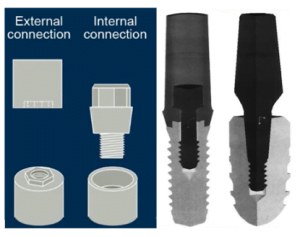 Dental implant with the external hexagon