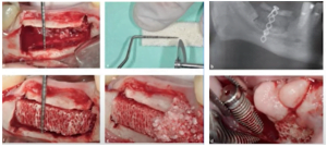 Surgical technique using xenograft to increase alveolar bone volume by the existing crest height plus additional xenograft material.